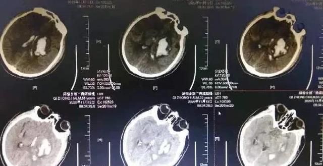 万一脑出血了，正规诊疗流程你知道吗？