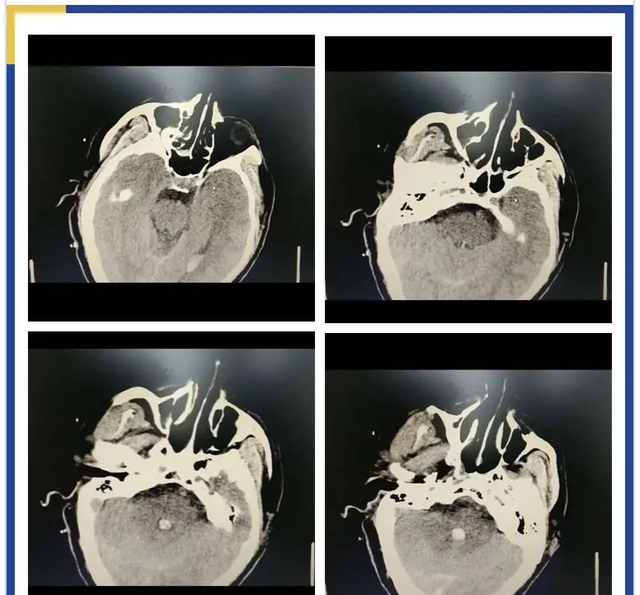 万一脑出血了，正规诊疗流程你知道吗？