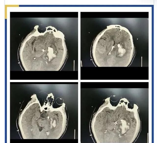 万一脑出血了，正规诊疗流程你知道吗？