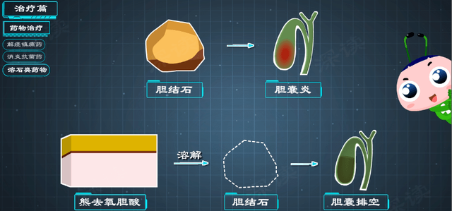 硬核｜胆囊炎需治胆结石？胆绞痛如何缓解？胆囊炎治疗门道多