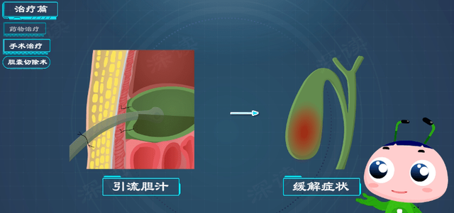 硬核｜胆囊炎需治胆结石？胆绞痛如何缓解？胆囊炎治疗门道多