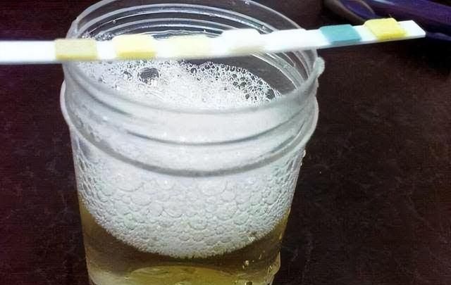 肾病患者出现蛋白尿，早注意这6点，治疗能少走很多弯路