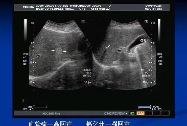 不少人B超、CT提示有“肝内钙化灶”，到底是什么意思？一文说清