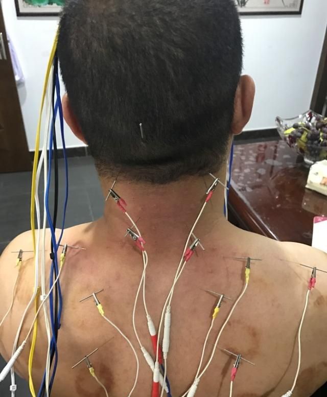 你对针灸了解吗?针灸是怎样起到治疗作用的呢图1