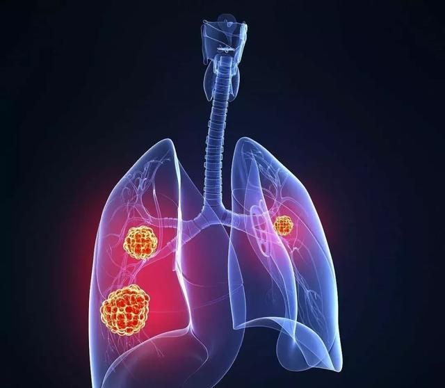得了肺癌怎么办？肺癌晚期有哪些危害？