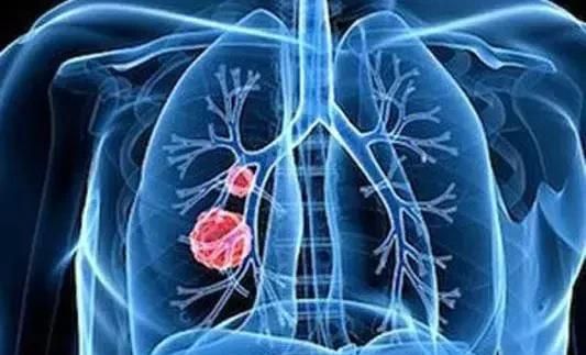 得了肺癌怎么办？肺癌晚期有哪些危害？