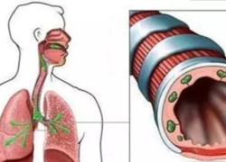 什么是支气管扩张？支扩的最佳食疗用药治疗方式