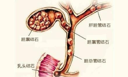 形成胆结石的原因有哪些？