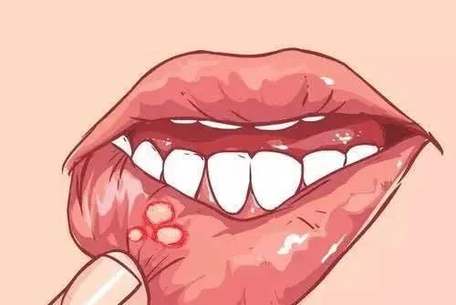 说说这个“难缠加难忍”的口腔溃疡病