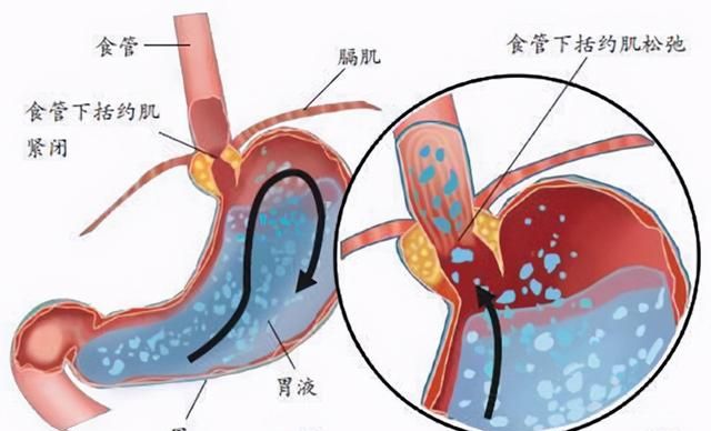 为什么浅表性胃炎反复发作难以治愈？听听医生怎么说