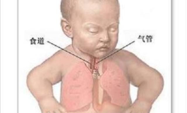 小儿肺炎很常见，但不重视可能会危及生命！！！