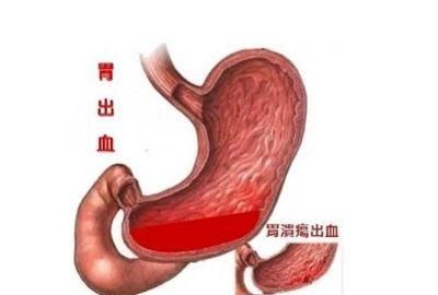 阿司匹林吃多长时间可以停用(阿司匹林服用多长时间可以停)图3