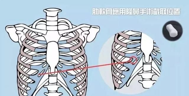 花什么几十万做鼻子？想要隆鼻好看，看完这一篇就够了！