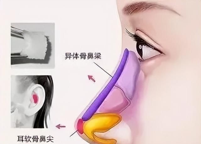 花什么几十万做鼻子？想要隆鼻好看，看完这一篇就够了！