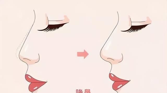 花什么几十万做鼻子？想要隆鼻好看，看完这一篇就够了！