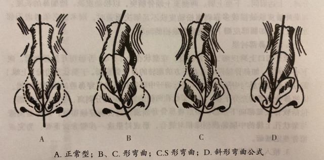 歪鼻矫正怎么做？术后如何护理？会不会反弹？