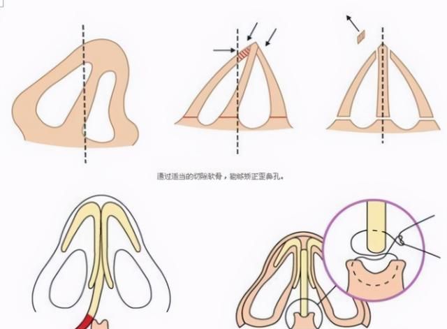 歪鼻矫正怎么做？术后如何护理？会不会反弹？