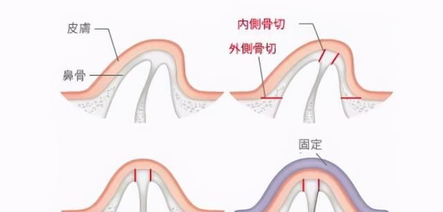 歪鼻矫正怎么做？术后如何护理？会不会反弹？