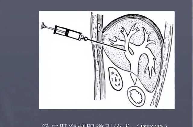 治疗不及时可能危及生命，急性胆囊炎有哪些治疗方法？