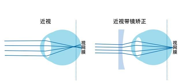 视力1.0=近视被治愈了吗？