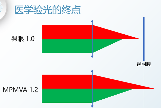 视力1.0=近视被治愈了吗？