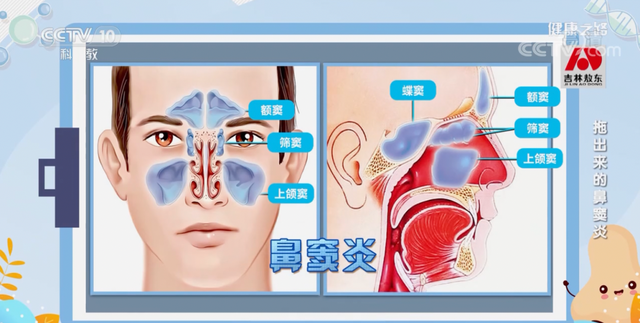 一个鼻窦炎，姑娘被切除半边脑壳