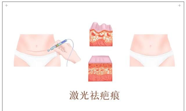 瘢痕瘙痒、留疤“很丑”，术后该怎么祛疤？