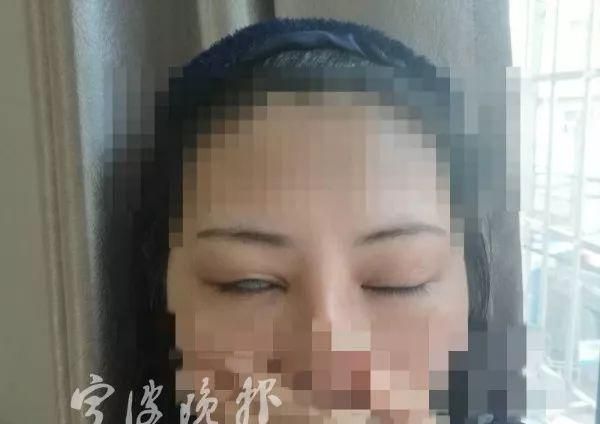 20岁女孩割完双眼皮眼睛闭不上了！这家整形医院竟说：这是最好效果了