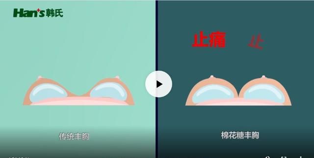 想让隆胸术后手感真实自然如何达到？