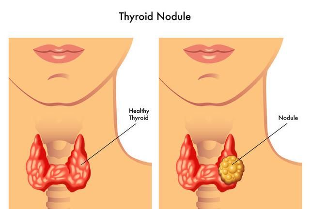 每个被甲状腺结节吓过的人，都该知道“钙化”的意思，别再糊涂