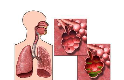 肺气肿疾病非常顽固，及时规范的诊治才是最主要的