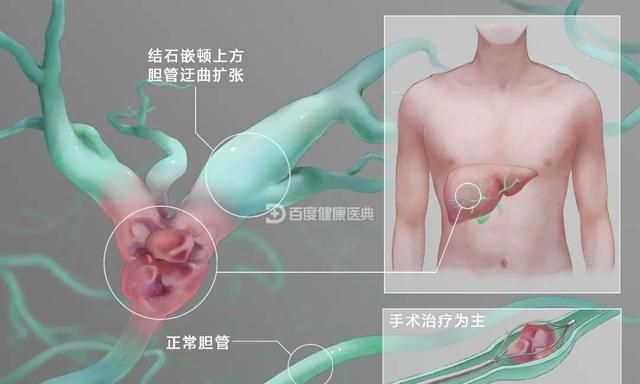 肝脏还能长结石？谈肝内胆管结石的保胆治疗