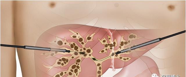 肝脏还能长结石？谈肝内胆管结石的保胆治疗