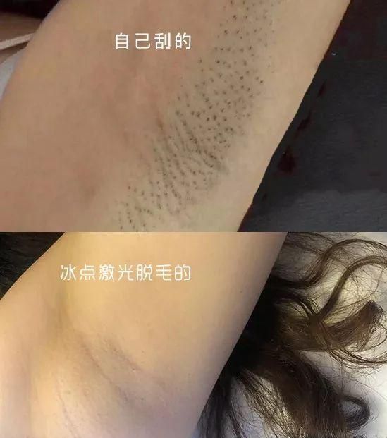 脱毛方法千千万，这个100块不到，让我彻底摆脱尴尬