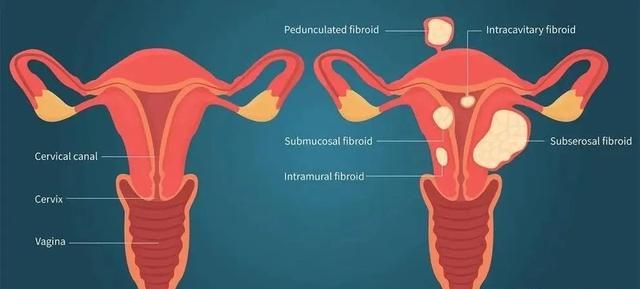 子宫肌瘤手术要多少钱-布谷医生