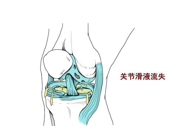 氨糖是什么？氨糖的作用是什么？这几类人群需了解