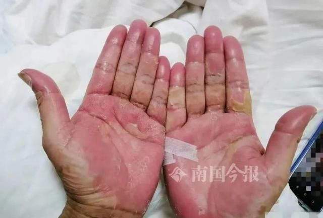 大补？蛇胆蛇血蟾蜍青蛙，轮番生吃下肚，柳州男子命悬一线