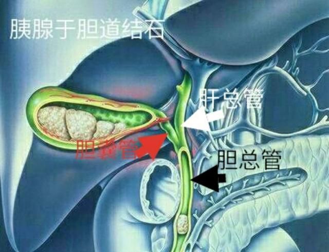 熊胆消石片对胆囊结石有什么样的效果呢图2