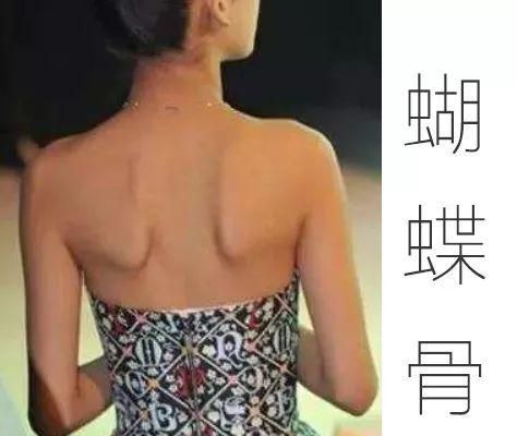 翼状肩胛骨的形成和纠正方式,如何用手法纠正翼状肩胛骨图5