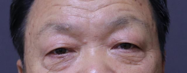 怎么去除眼袋(怎么去除眼袋和黑眼圈)图2