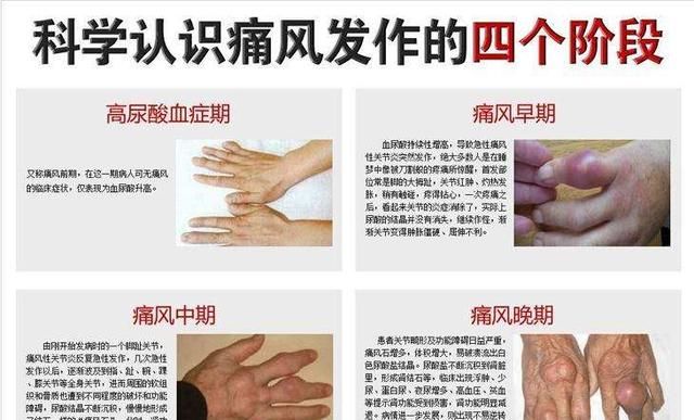 痛风怎么治疗,痛风怎么治疗才能除根图1
