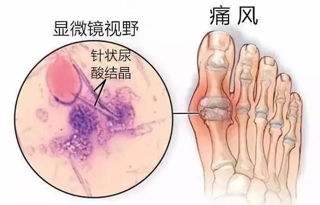 痛风怎么治疗,痛风怎么治疗才能除根图2