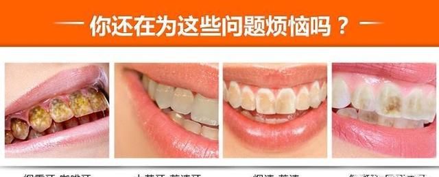 洗牙有什么好处,洗牙对牙齿有好处吗图8
