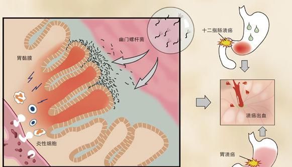 胡椒治胃溃疡最快的方法(胃溃疡能吃胡椒吗)图3