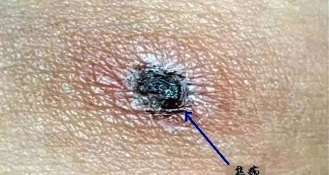 紧急提醒！出门一定要小心它！否则被咬后，可能命就没了